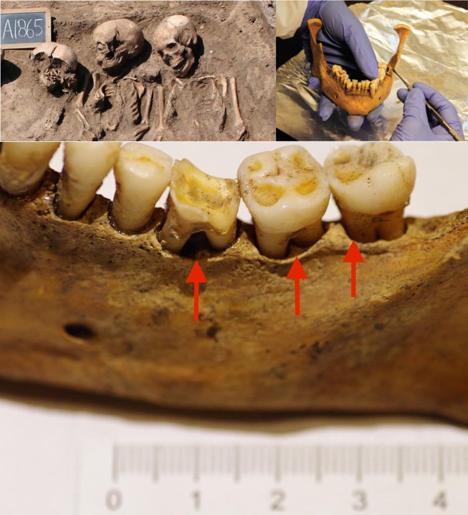 Ученые опровергли миф о "плохих зубах" средневековых европейцев 